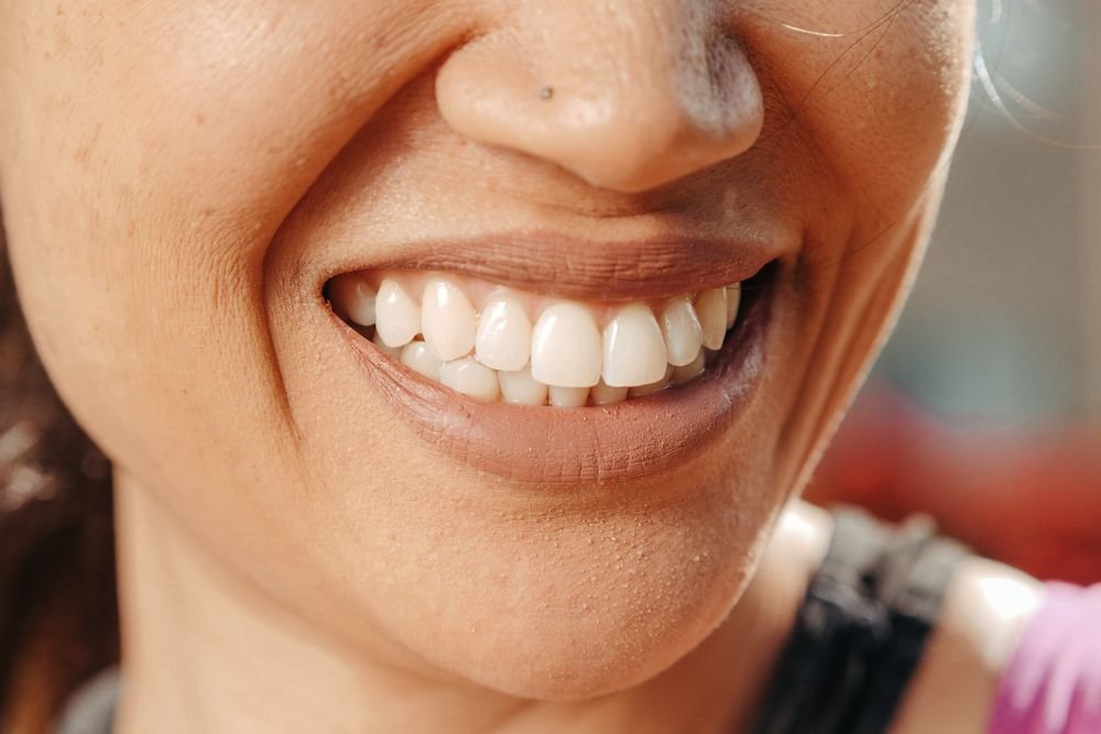Primer plano de una sonrisa con carillas dentales