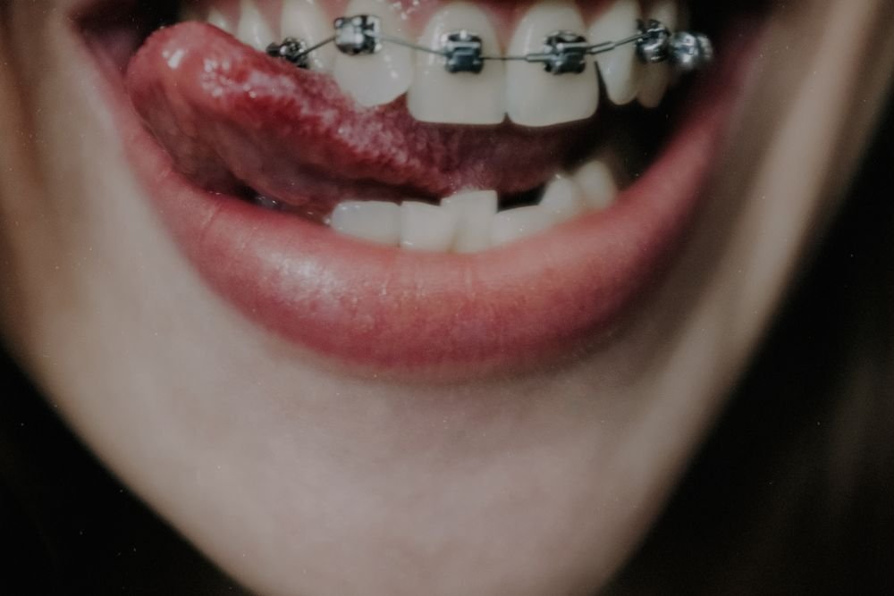 Joven sonriendo con brackets de ortodoncia